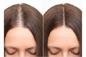 Hair loss – before and after