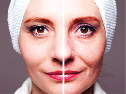 Skin rejuvenation and tightening – before and after