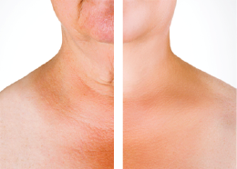 Neckline and decolletage – before and after
