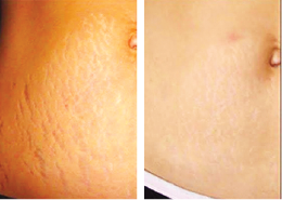 Hand rejuvenation – before and after