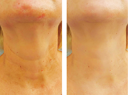 Neck rejuvenation – before and after